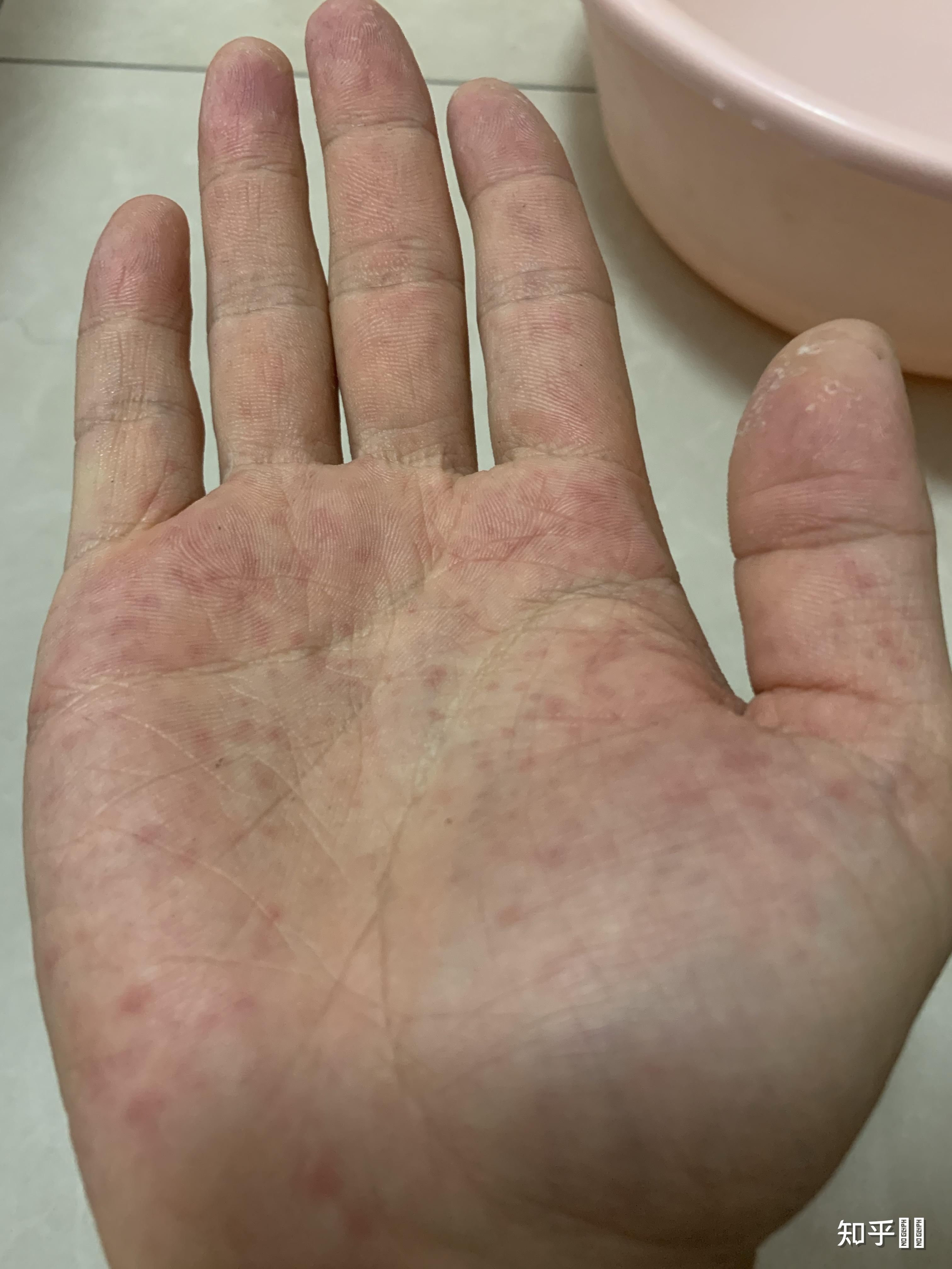 一到春秋两季,双手手心就会出现红点,很疼,略痒.