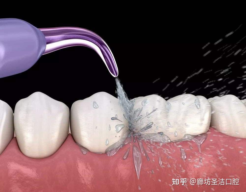 洗牙是指用潔治器械,通過高頻,高能振動把牙齒表面的牙結石,牙漬擊碎