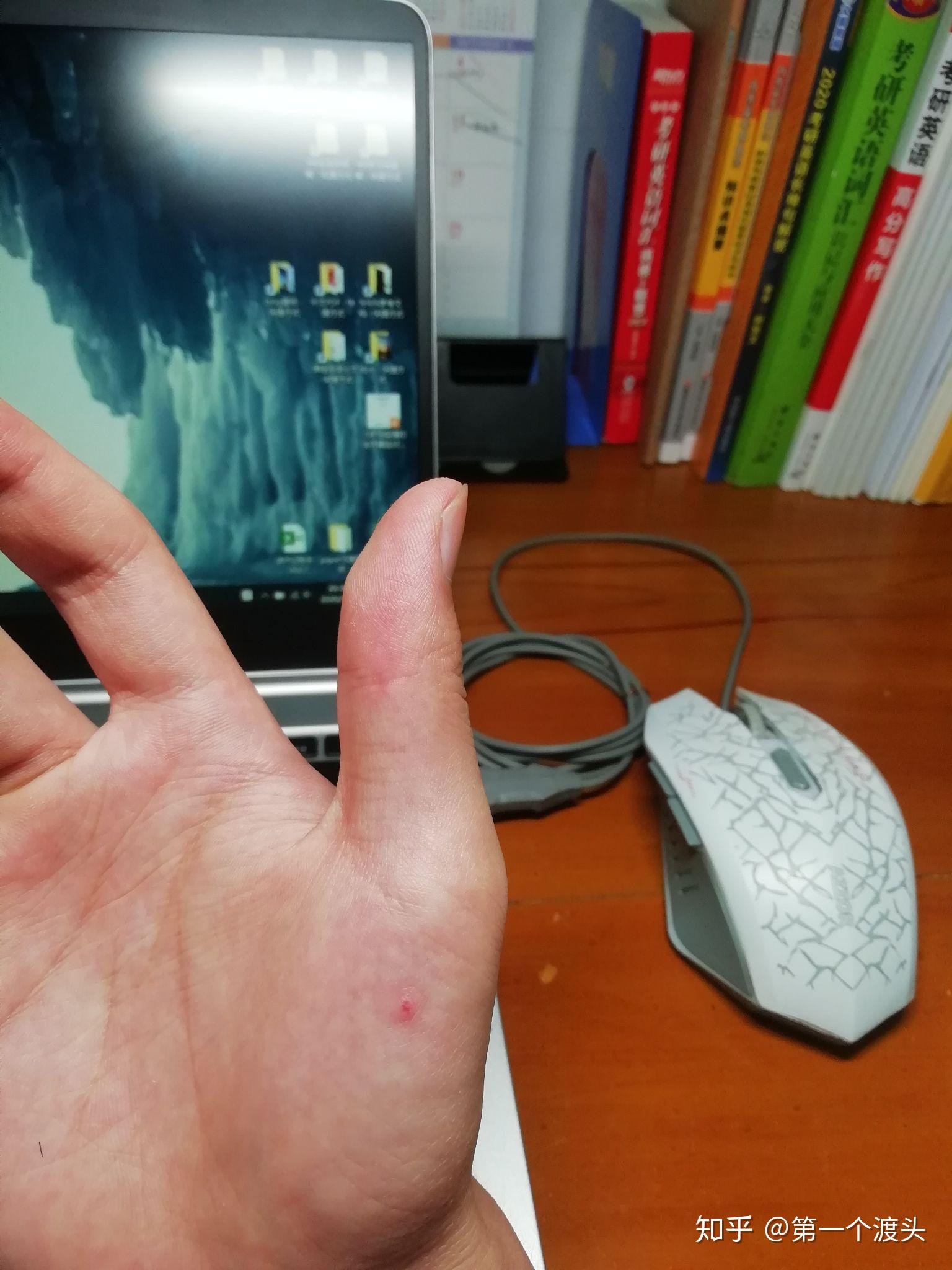 这是血管痣吗? - 知乎