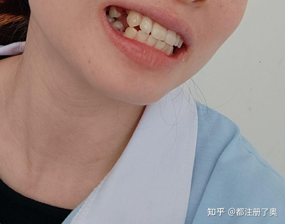 第二次拔左侧两颗4号牙