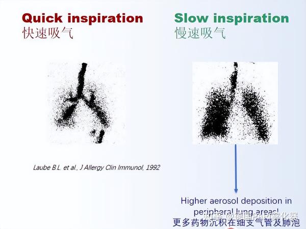 雾化时呼吸不对?别怕!SPRINT雾化杯可以解决! - 知乎