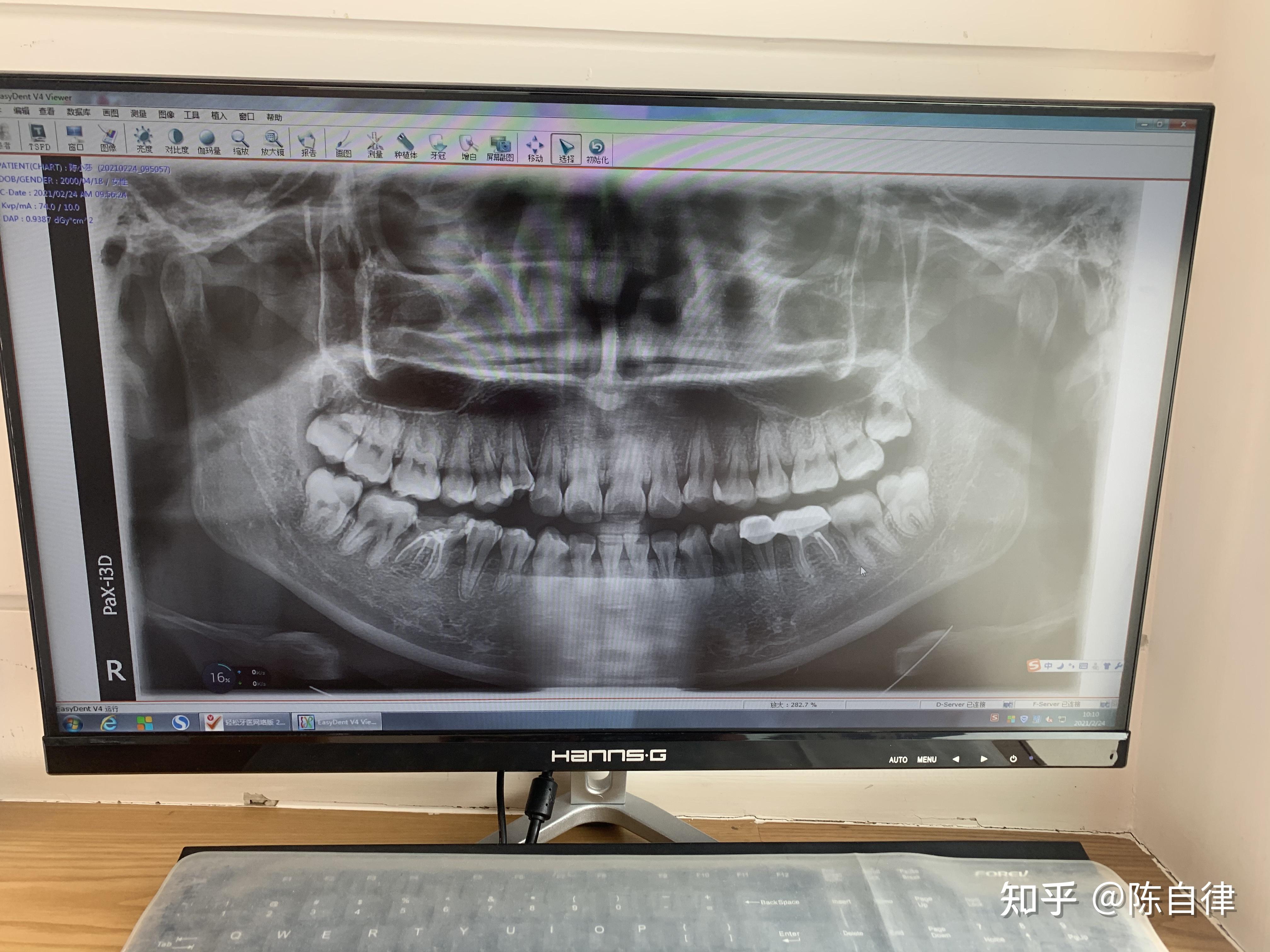 能帮我看看我的牙片吗有两颗做了烤瓷牙连冠有黑线好怕里面的牙烂掉