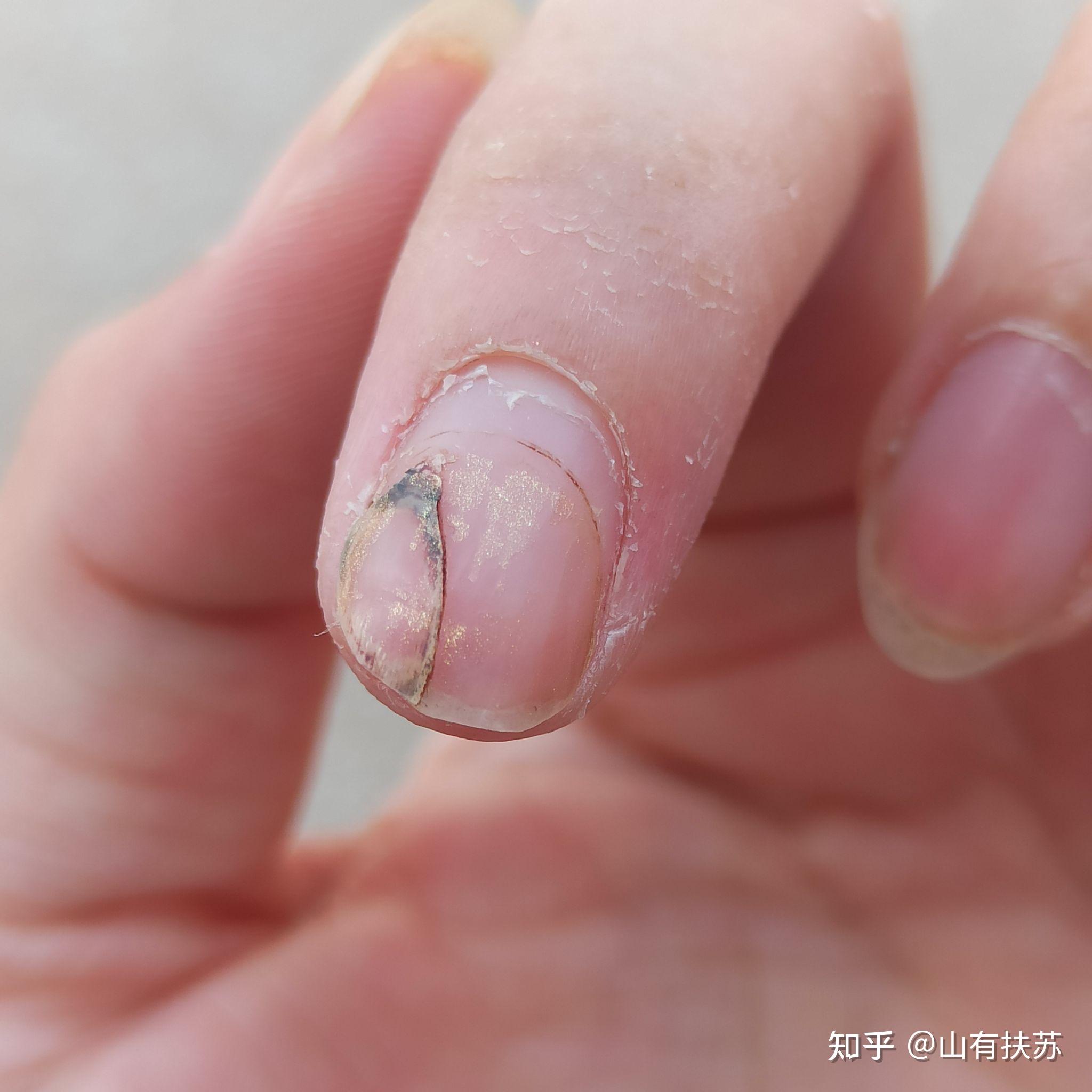 手指被切下一块肉,多长时间能恢复? - 知乎