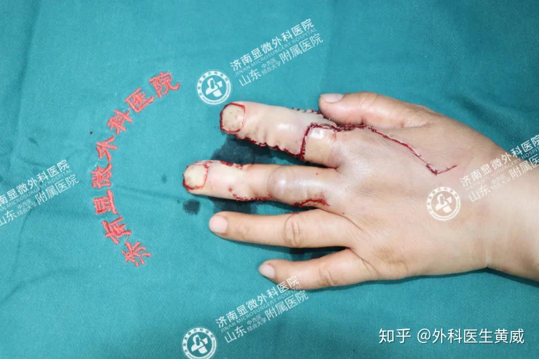 「再造手指」女子被压面机吞掉两根手指,14小时后奇迹复原