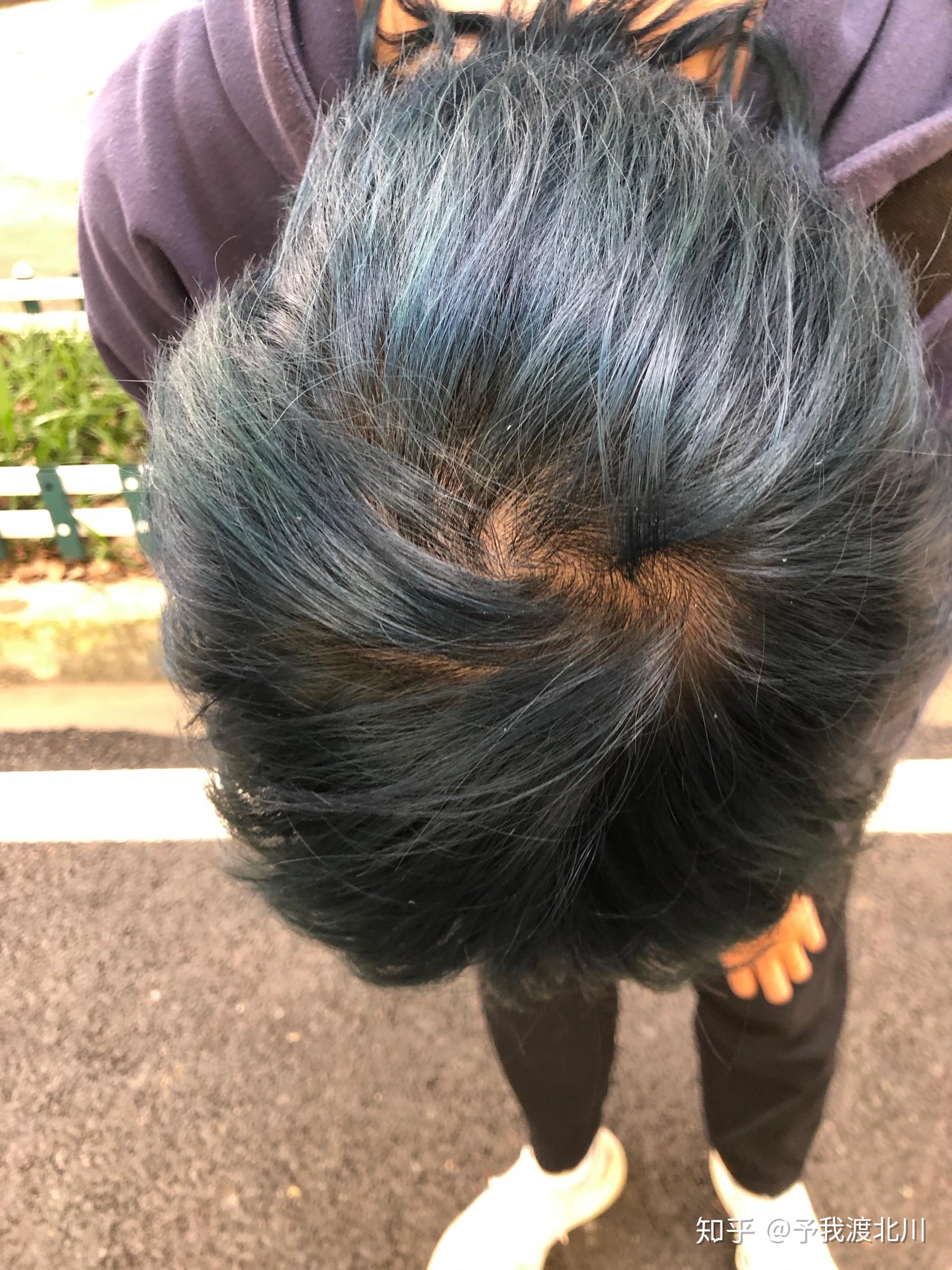 染头发的时候后脑勺头皮很刺痛 以为是正常现象没在意 结果现在wwww