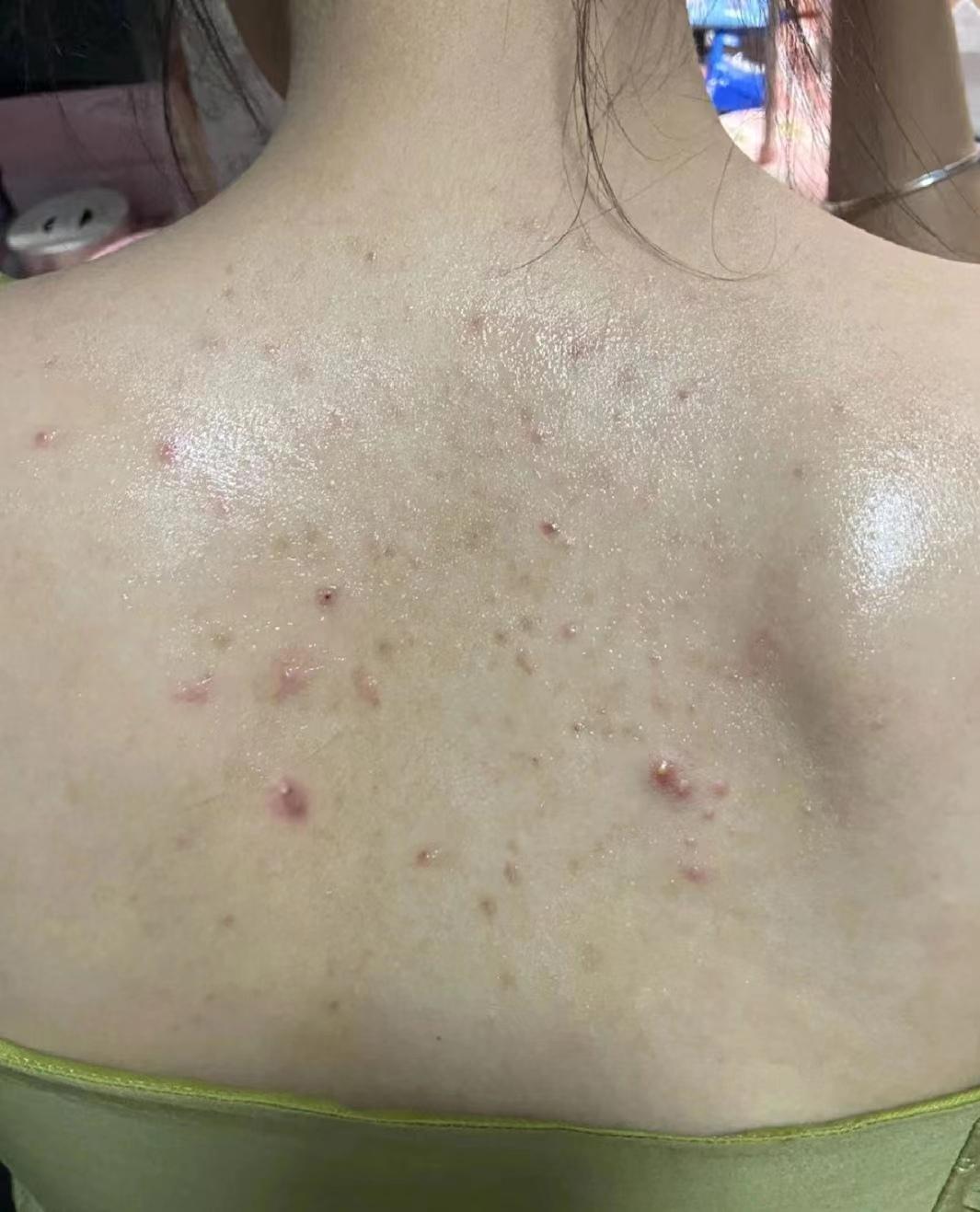 螨虫性皮炎怎么治忽然间全身都起了红点而且还在扩散医生说是螨虫性