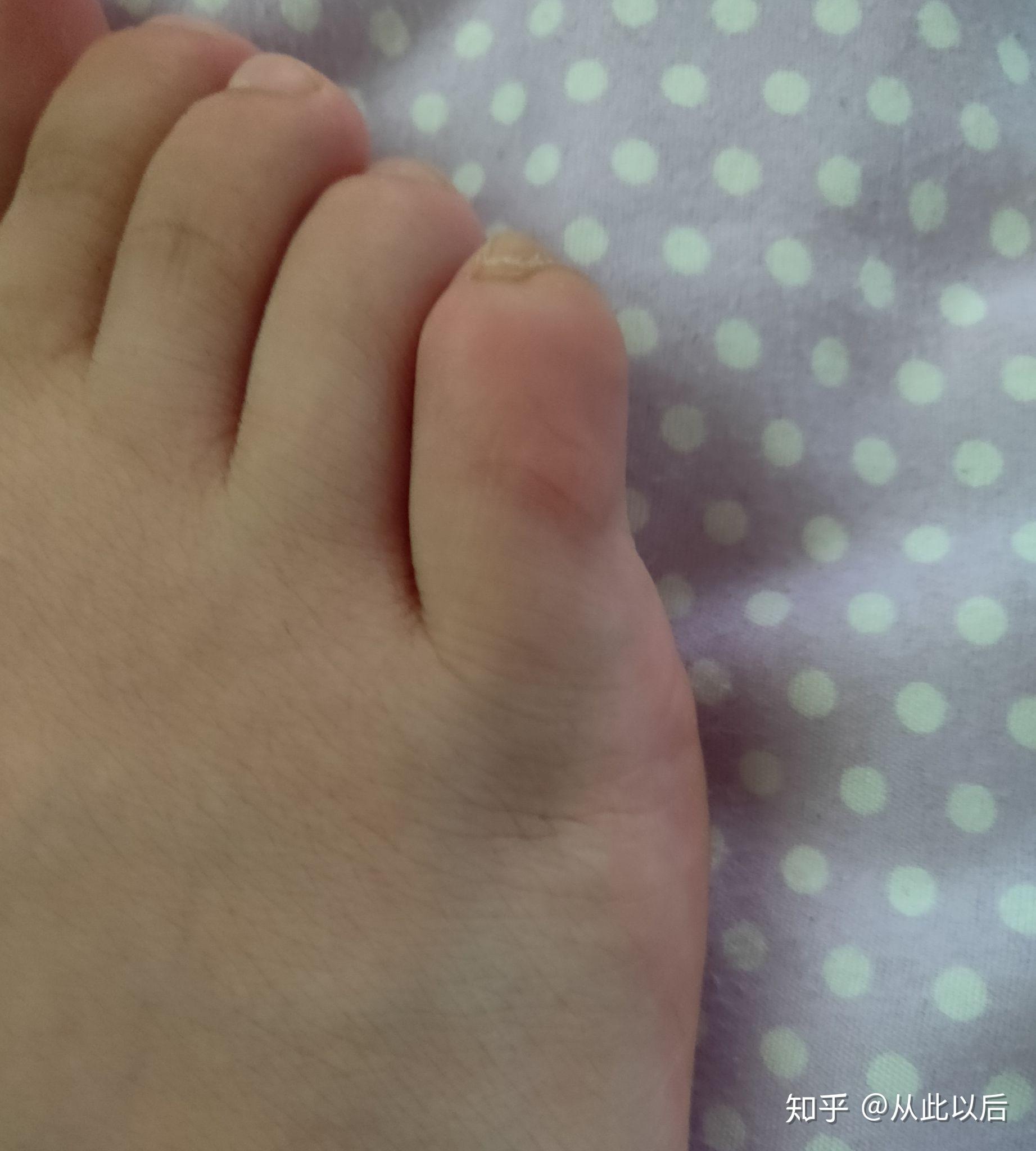 脚上小拇指起了个疙瘩硬的一碰就很疼走路磨的疼这是茧子吗