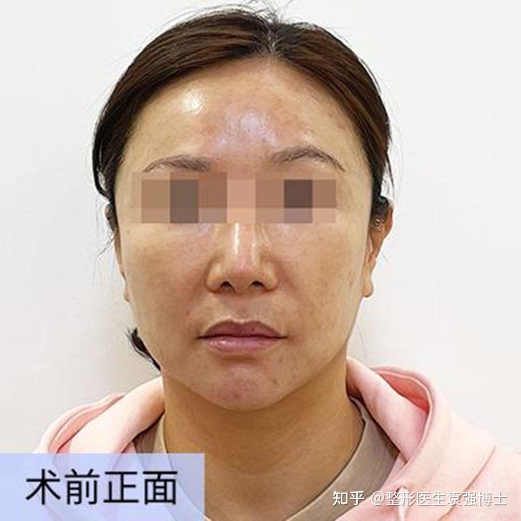 中年妇女整容手术前的笑脸特写。皮肤护理皱纹的脸。前后抗衰老拉皮治疗。面部皮肤护理和轮廓。照片摄影图片_ID:398752298-Veer图库