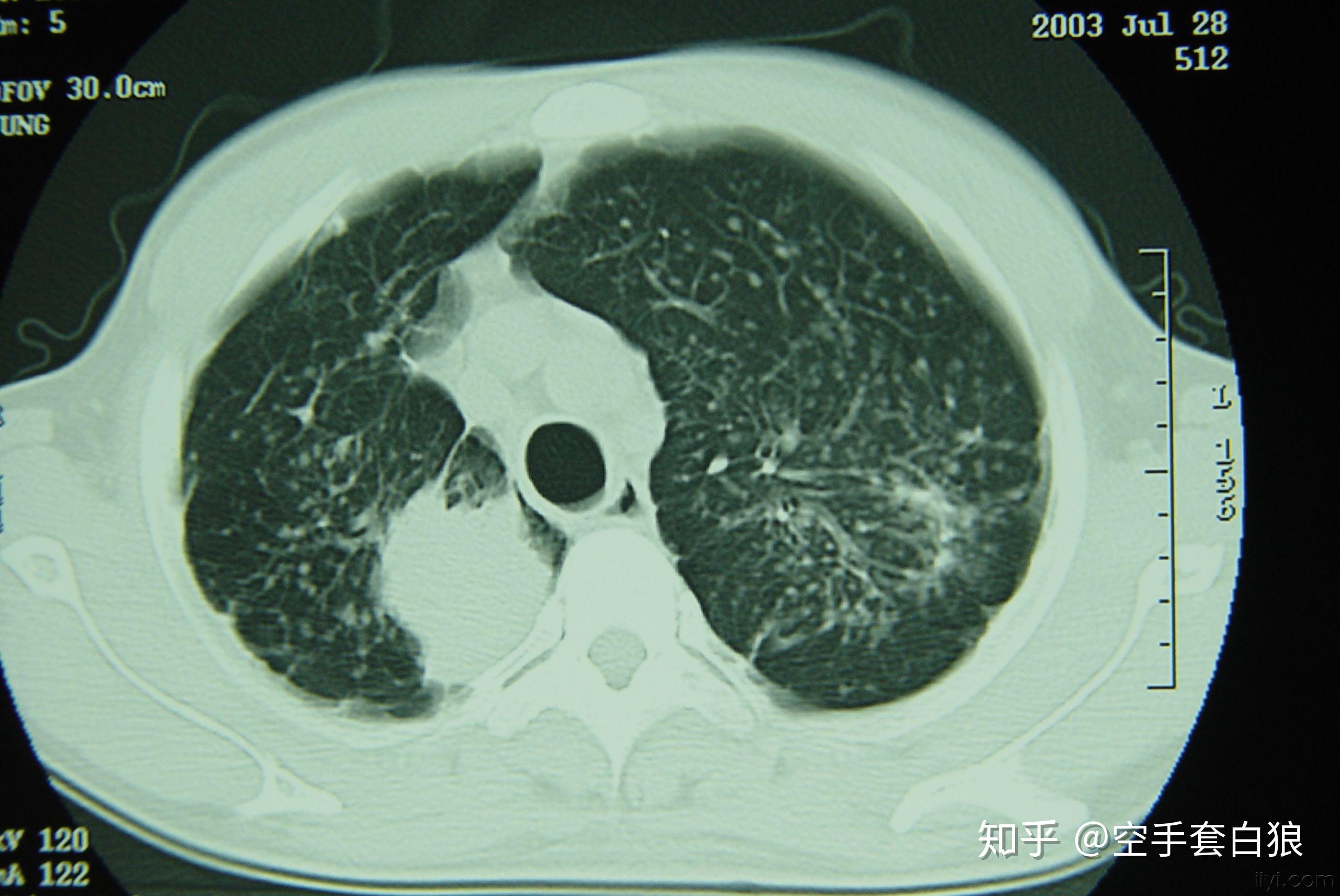 肺纤维化会有什么后果? 