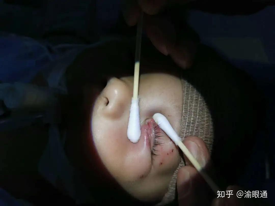 重庆永川的1岁1个月的幼童小锡被自己家的狗咬伤眼睛,泪小管断裂