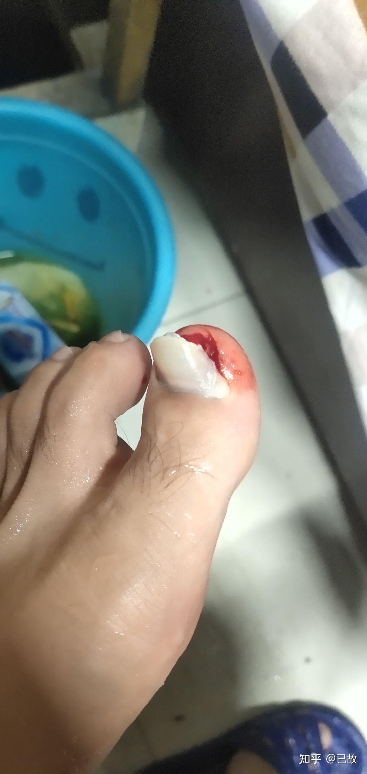 拔指甲是什么样的体验很疼么