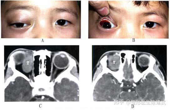 眼袋不对称浮肿竟然可能是眼眶肿瘤