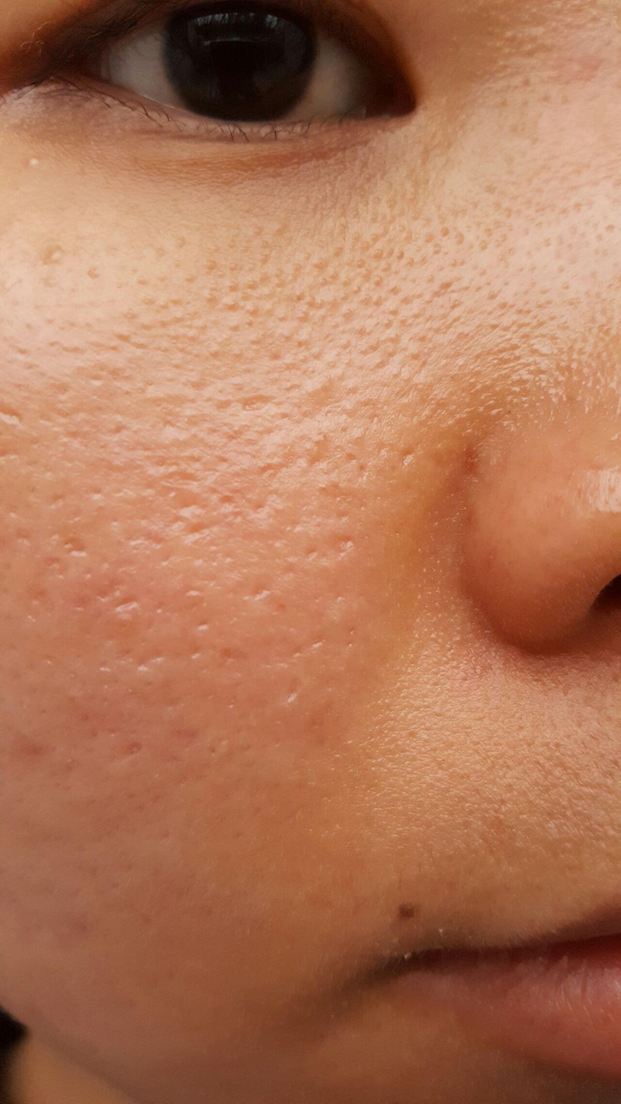 皮肤差痘坑多的女生会有男生喜欢吗