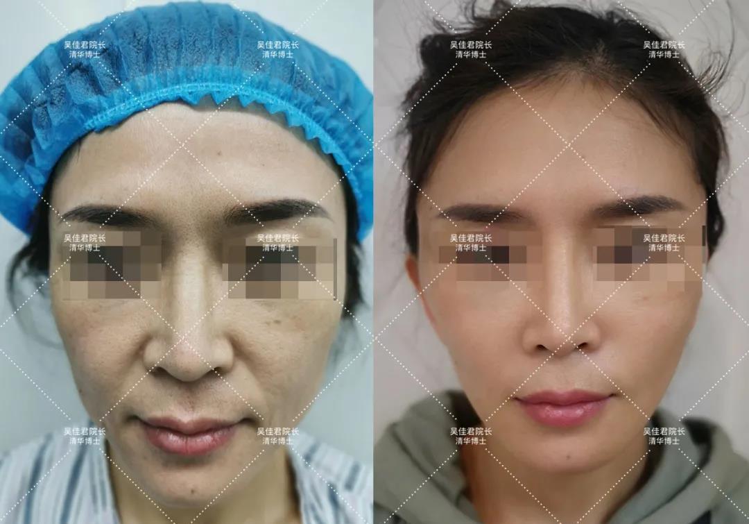 自己怎么做面部拉皮 v2-3369ea945bc7e2cd58ccf40731cd0ddb_1440w.jpg?source=172ae18b