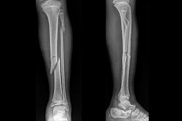 性骨折和开放性骨折,按骨的损伤性程度可分为:不完全性骨折(裂缝骨折
