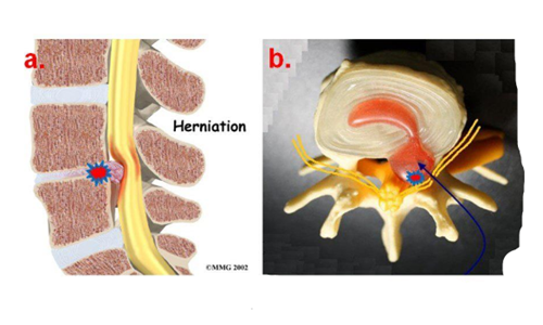 什么样的腰椎间盘突出容易压迫马尾神经呢让我们来看看