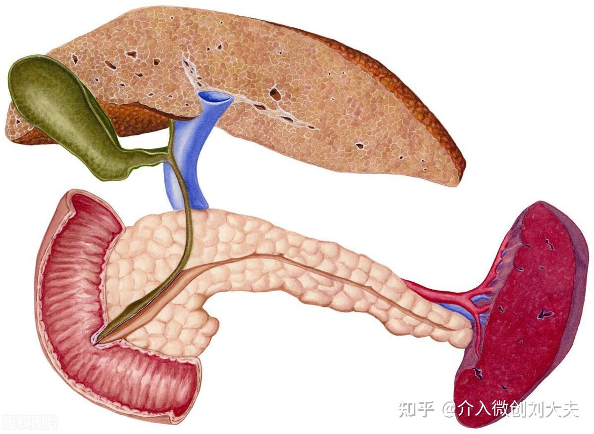 肝硬化食管胃静脉曲张破裂出血该如何选择手术:TIPS分流 OR 外科断流? - 知乎