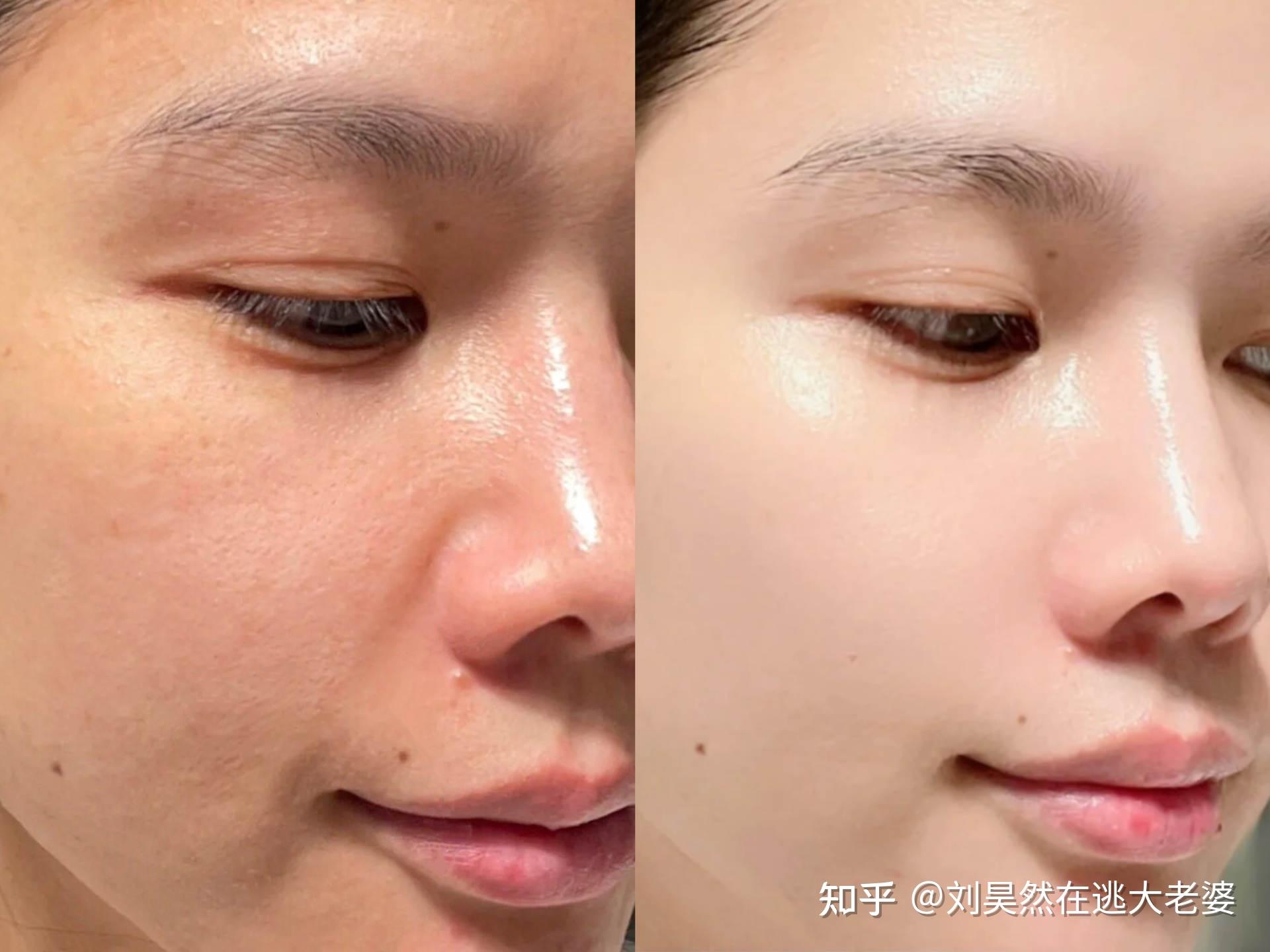 粗糙暗黄的皮肤,芳龄二八别人眼里看着像三八…这对比图够直观吧!