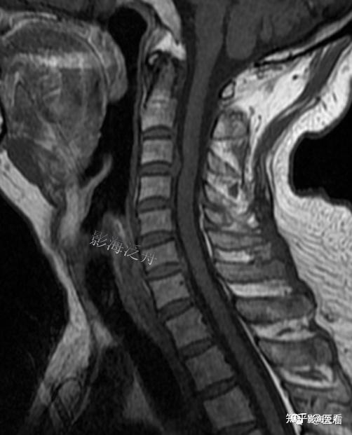 典型病例頸椎後縱韌帶鈣化mr