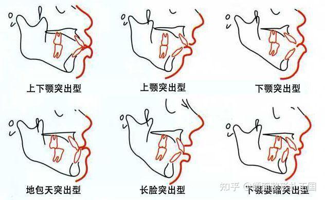 嘴巴突出怎么矫正图片