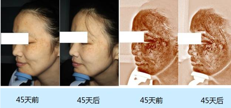 治疗黄褐斑的专家研讨共识纳晶氨甲环酸联合治疗