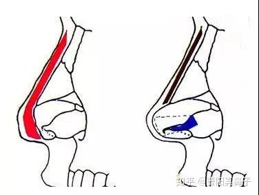 隆鼻后鼻尖发红是什么原因造成的