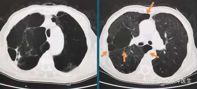 右肺尖肺大泡图片