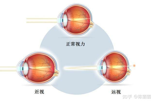 近視眼遠視眼等人的各種眼睛看到的世界各是什麼樣子的