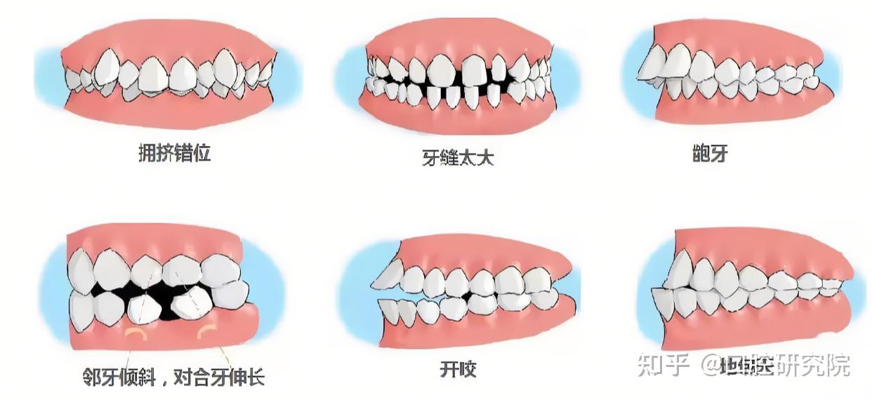 常用牙齿矫正器的类型与参考价格