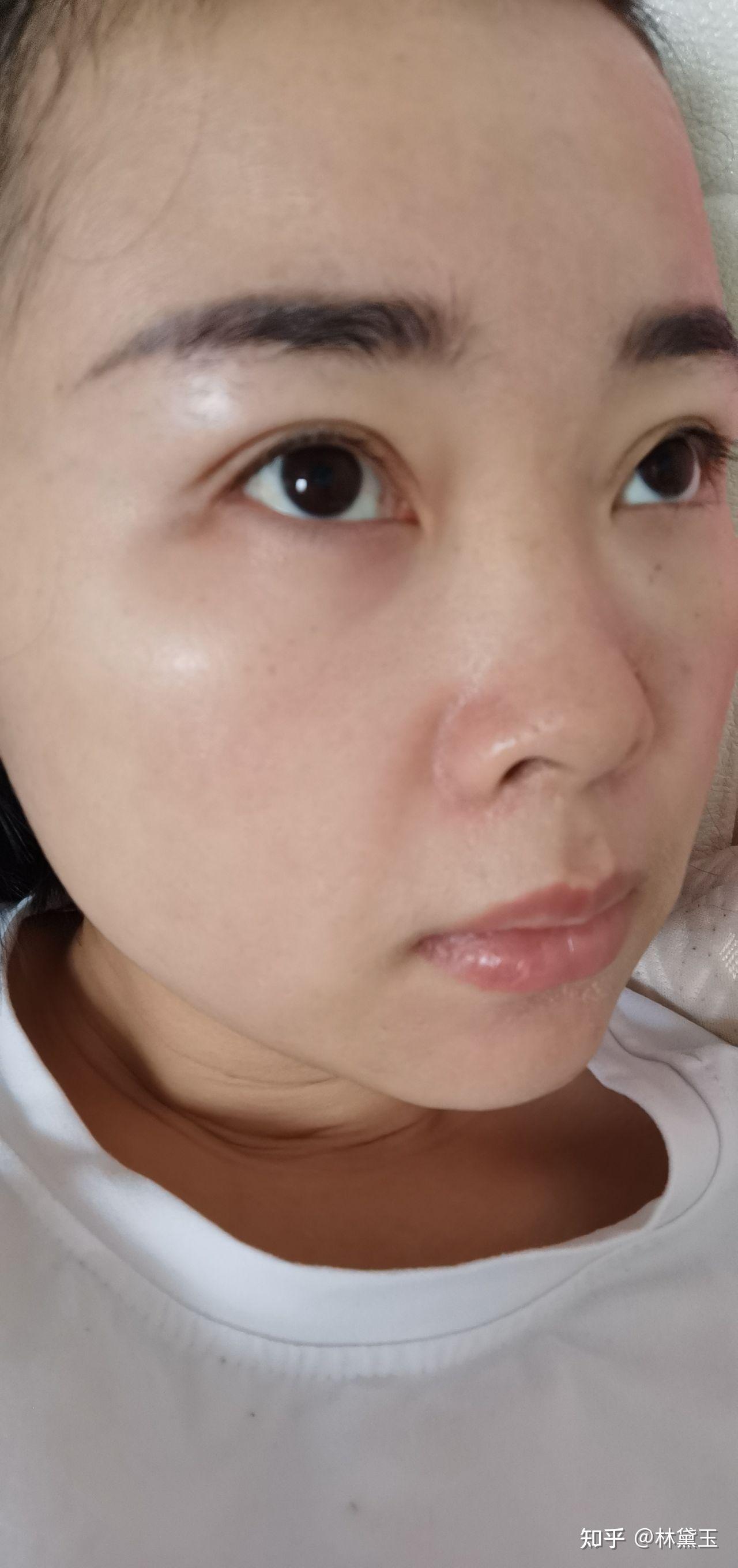 微针第三天 - 知乎