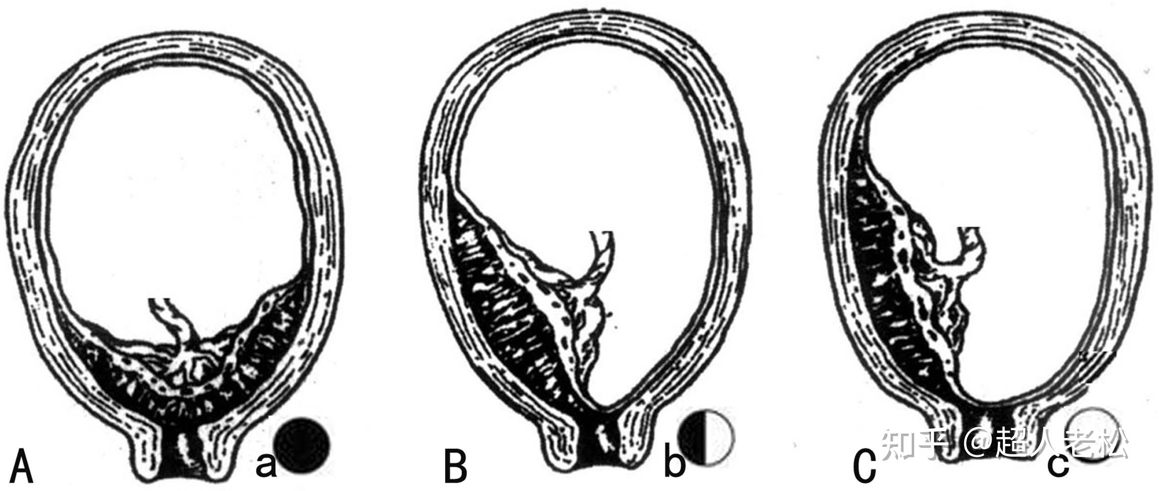 第六节 阴式全子宫切除术及阴道前后壁修补术