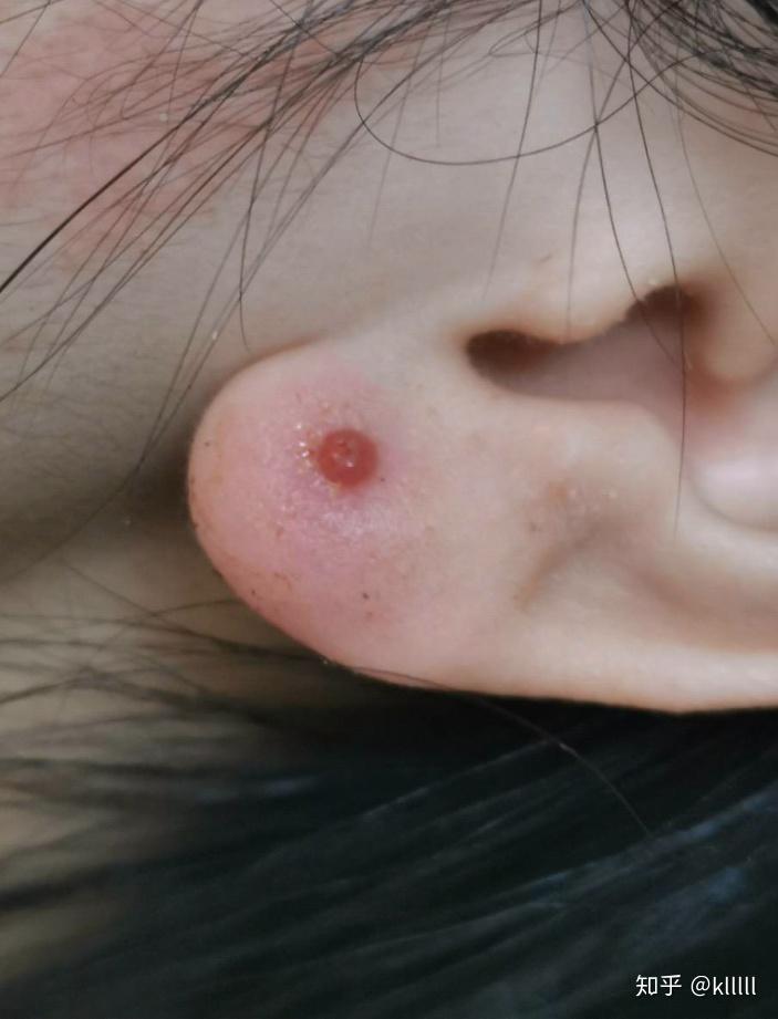 打了三个月耳洞耳洞旁边长了一个像是血包的东西不知道是什么怎么办呢