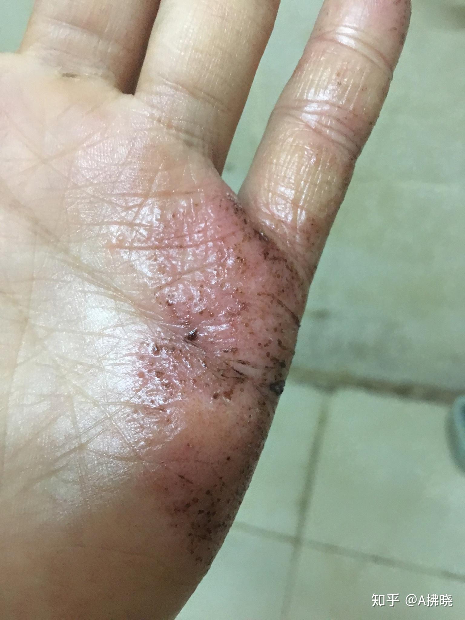 湿疹银行汗疱疹近期治疗效果