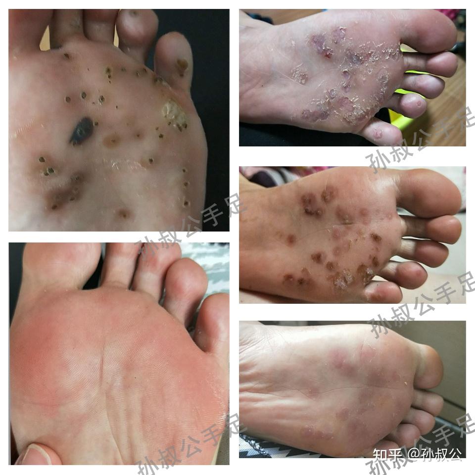 跖疣冷冻能好吗今天做冷冻好疼啊