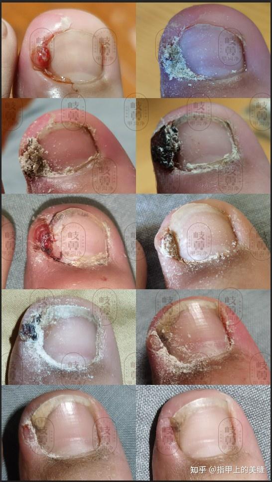 甲沟炎长了肉芽不想拔甲怎么办