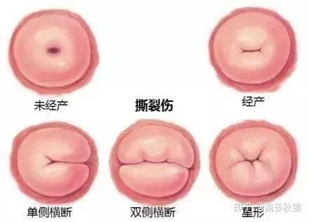 (未产型完整宫颈和产后陈旧裂宫颈图片)在这个过程中,薄薄的宫颈难免