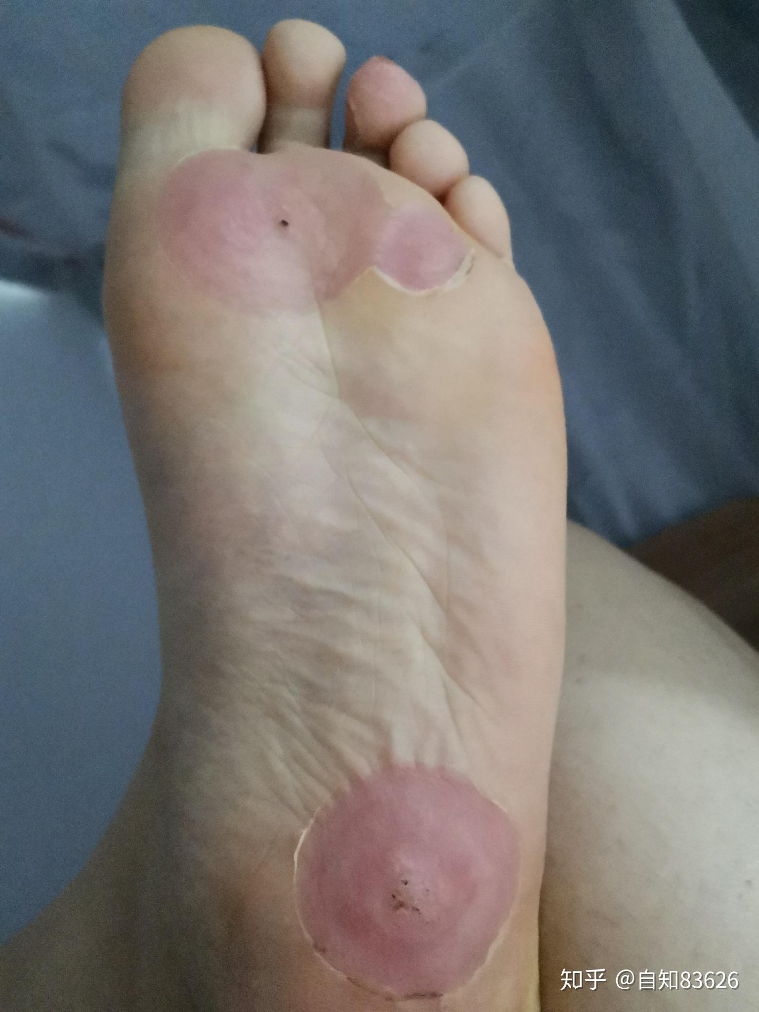跖疣冷冻后恢复记录