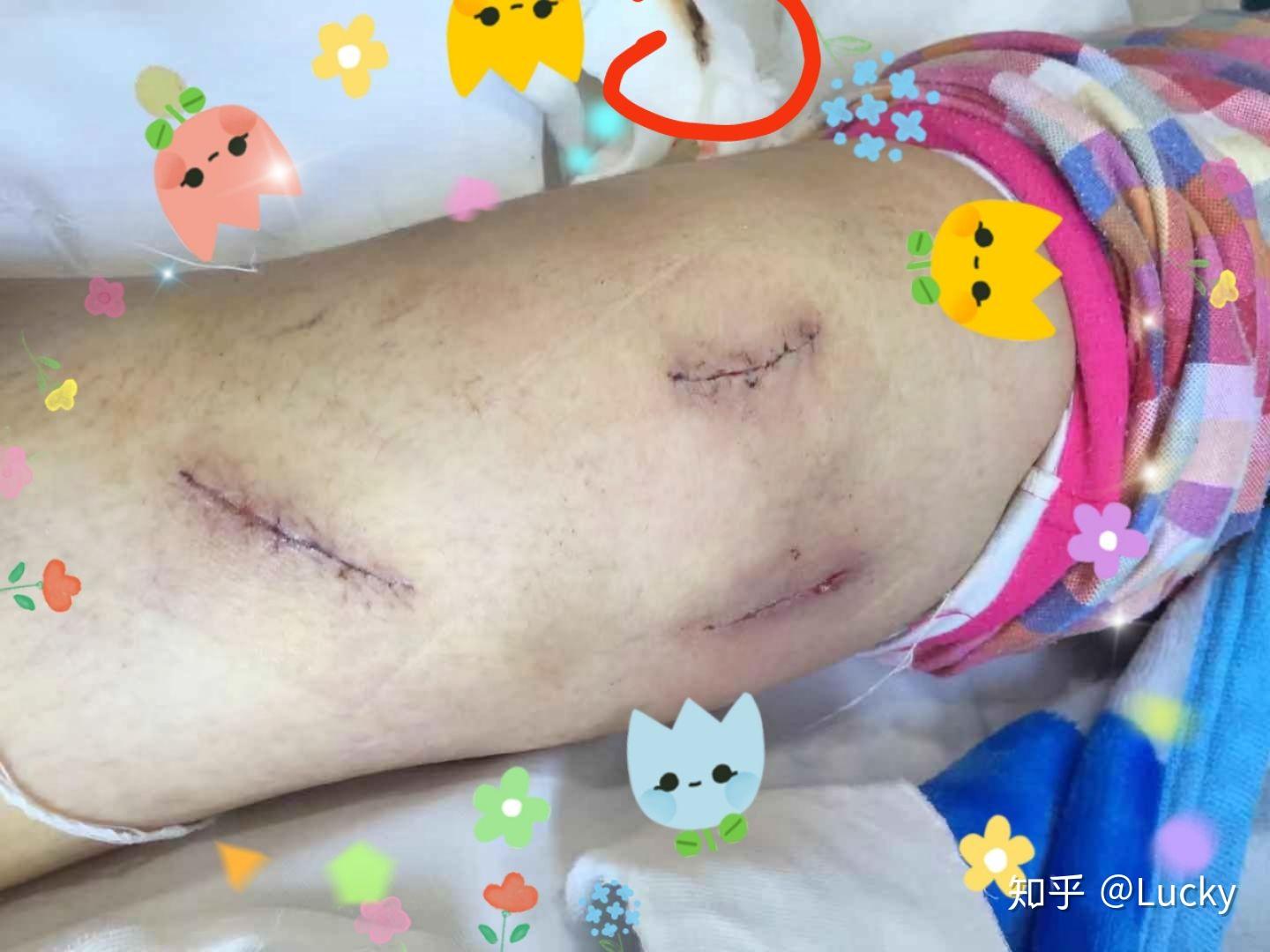 习惯性髌骨脱位手术是个什么感触? - 知乎