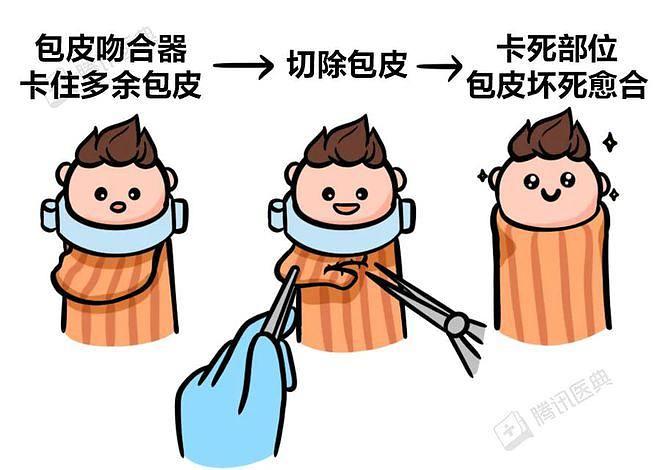 割包皮到底有多痛? - 知乎