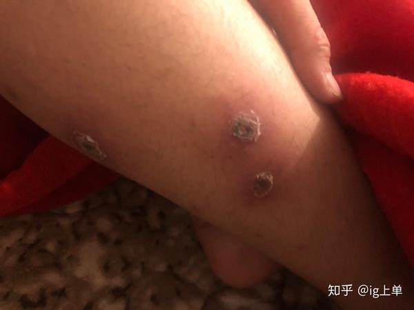 脚脖子上长不知道什么东西里面还起脓