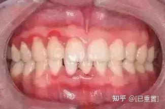 牙缝里长草莓？不清洁牙齿的代价有点大！
