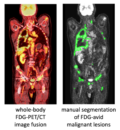 融合 PET/CT 精准分割 0.017%病变区肿瘤：MICCAI AutoPET 2022 挑战赛冠军方案介绍 - 知乎