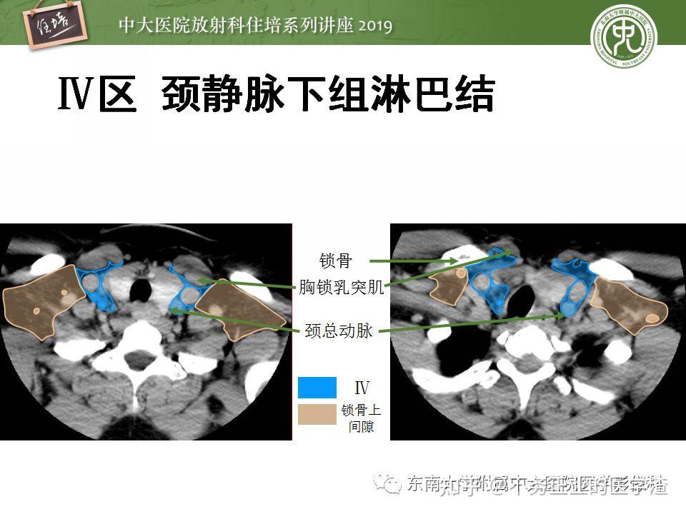 2013颈部淋巴结分区