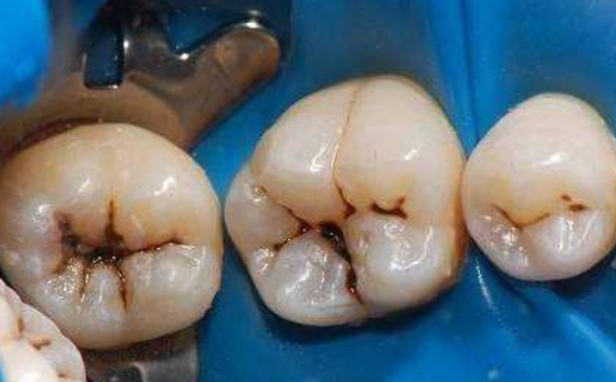 15岁儿童牙齿有黑斑，排列不齐，黑斑是何原因造成？矫牙需要拔掉四颗牙齿，是否有必要（附牙齿图片）谢谢_百度知道