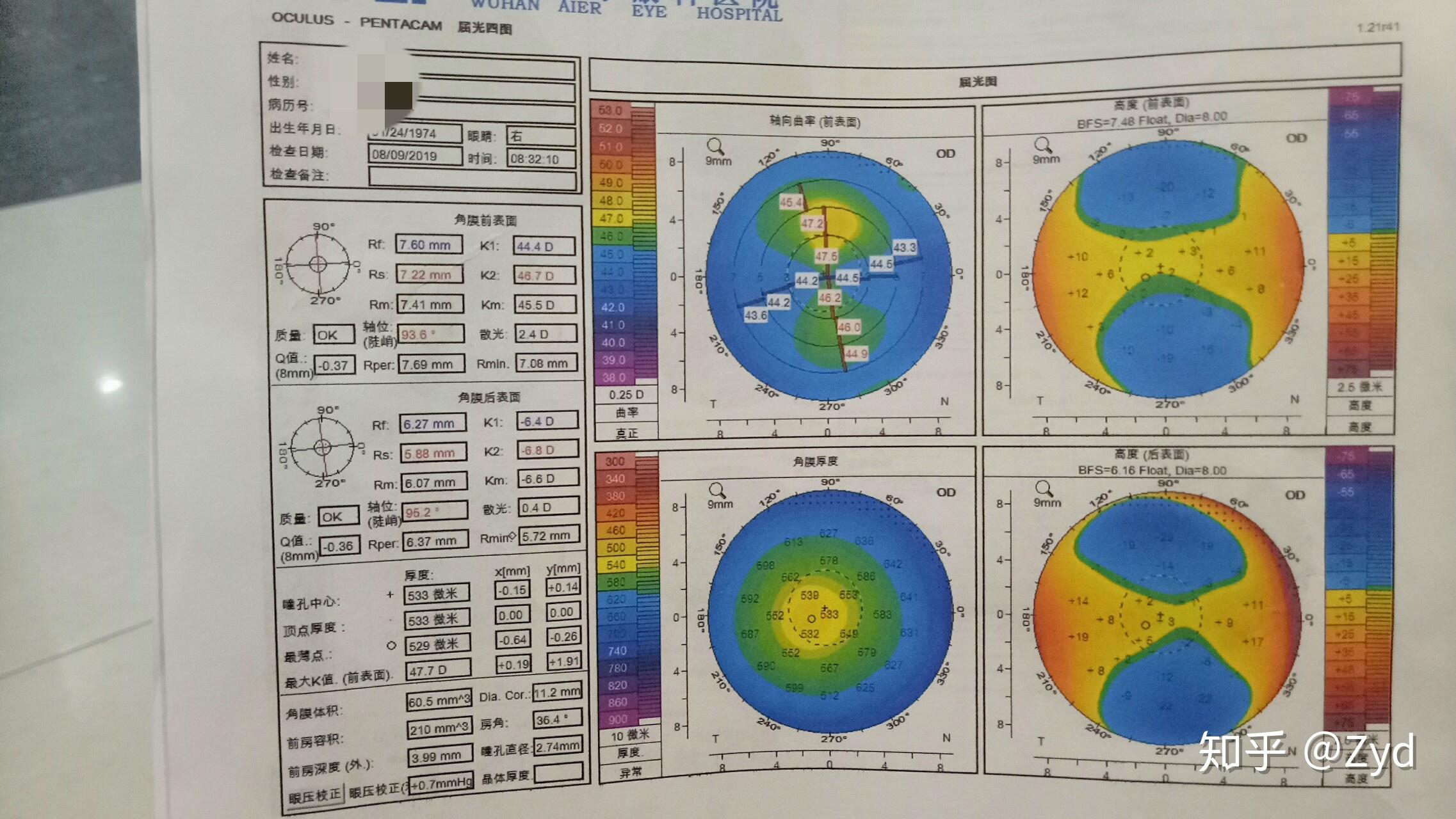请大神看一下角膜地形图,是不是不规则散光,晚上看东西上下重影?