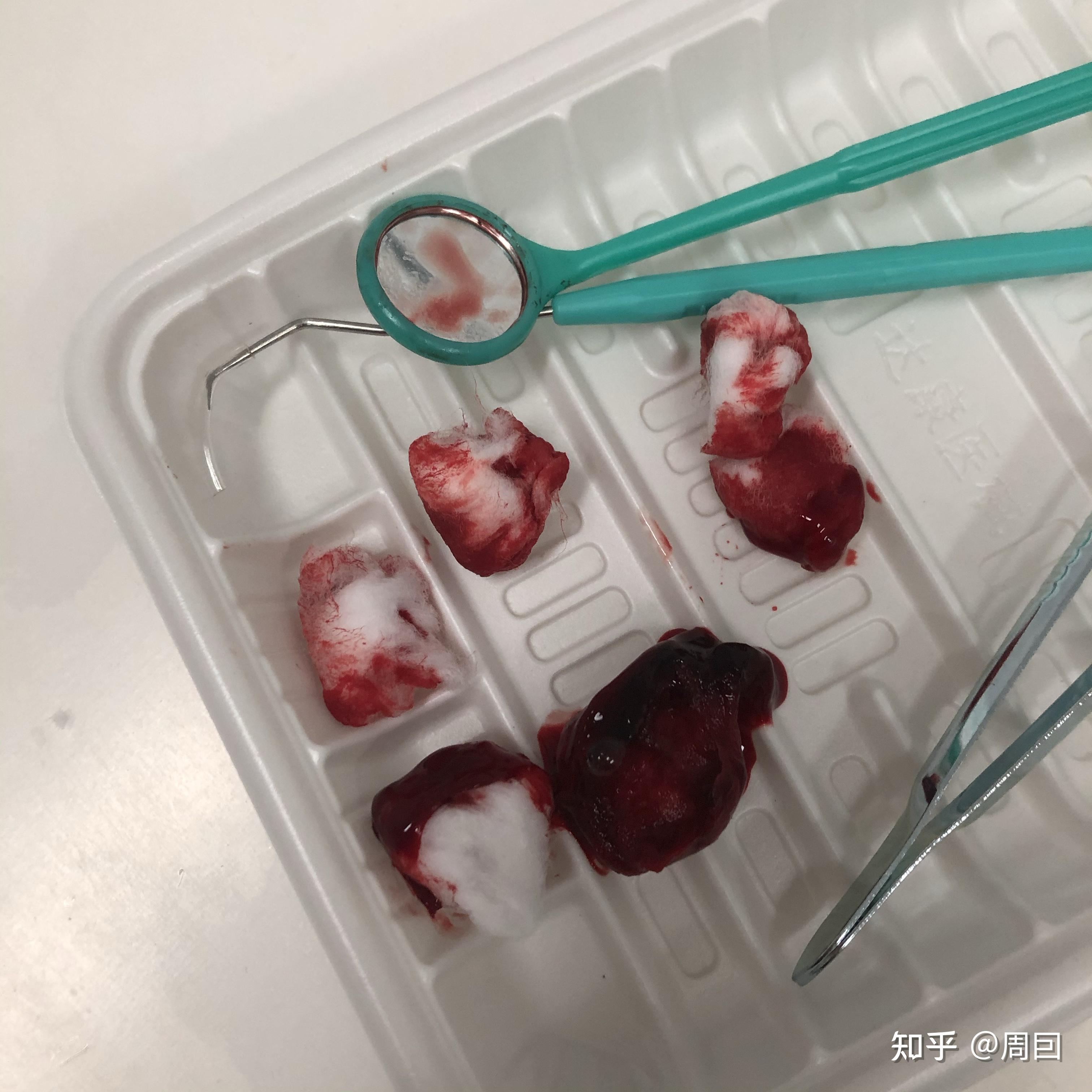 到了凌晨四点,血慢慢止住了,医生在我嘴里继续塞棉球,让我回家,到了