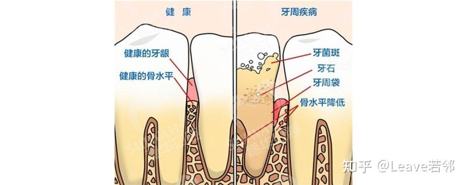 那么会给我们的牙齿带来以下影响 牙周组织炎症牙龈下方的牙结石和菌