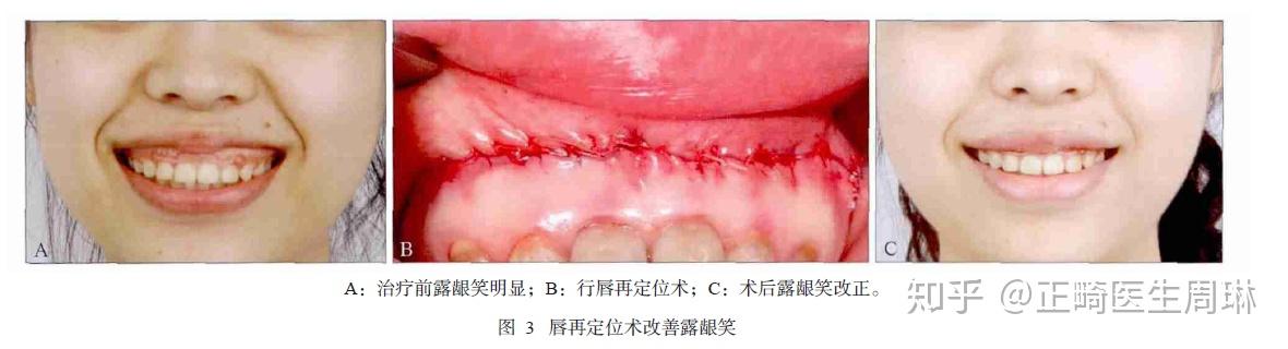 即通过调整上唇系带及前庭沟软组织使前庭沟形态发生变化来限制上唇提