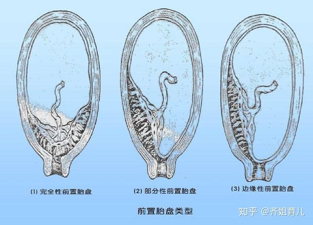 胎盘图片 后壁图片