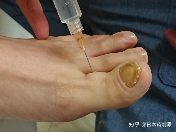 3 1个小时后麻醉失效,治疗结束.